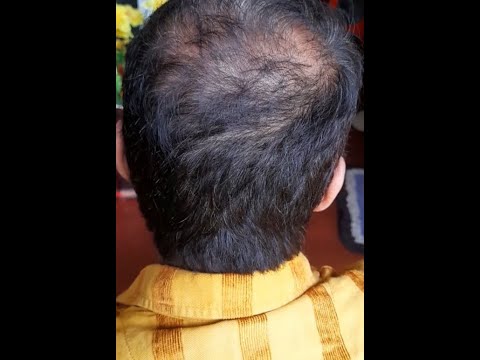 World best hair mask for baldness and hair growth /නලල දෙපස කොන්ඩේ නැද්ද/   🌵💧 /#shorts/hair fall