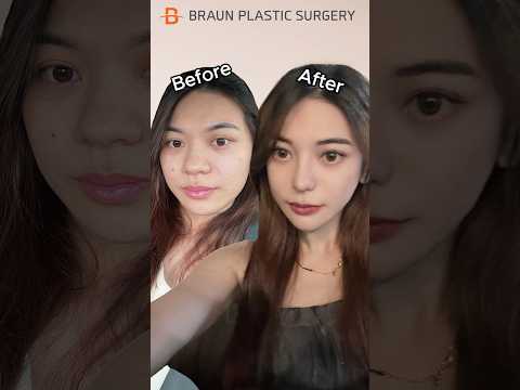 Yes I got plastic surgery, and?😎 #fyp #glowup #beforeandafter #rhinoplasty #facialcontouring