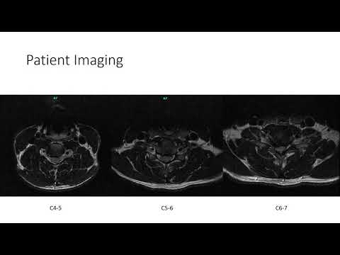 AANS Coding Shorts: Posterior Cervical Decompression and Fusion