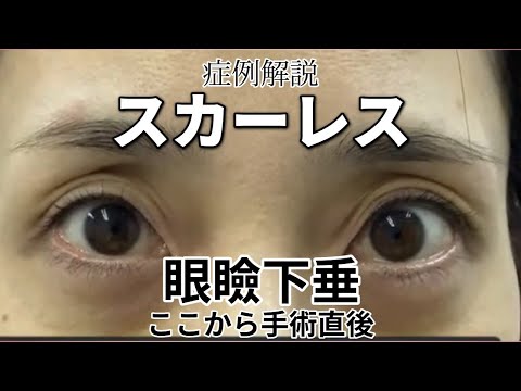 スカーレスで眼瞼下垂の症例解説。名古屋　こいずみ形成クリニック