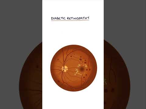 Diabetic Retinopathy #medicine #medicalstudent #ophthalmology #optometrystudent #endocrinology