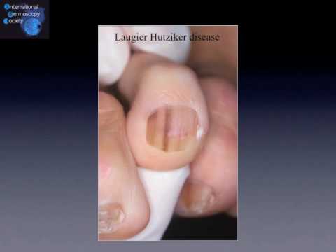 Nail pigmentation (beginners level) by Dr. Luc Thomas