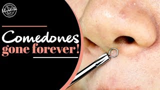 Comedones Removal | Blackheads  को दूर भगाने का बेजोड़ उपाय | Dr. Nivedita Dadu's Dermatology Clinic