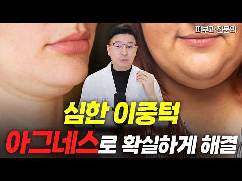 심한 이중턱은 아그네스로 개선하면 됩니다. 수술은 무섭고 울쎄라와 브이올렛으로 시술하기엔 제한될 경우