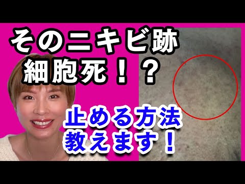 そのニキビ跡細胞死！？止める方法教えます！