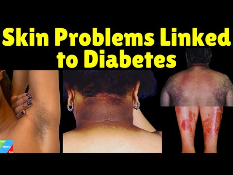 Diabetes Skin Problems | Diabetes Skin Signs | Diabetes Skin Manifestation & How to Prevent them