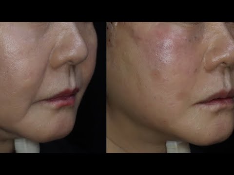 실패한 거상수술은 어떻게 치료할까 How to treat a failed face lift surgery