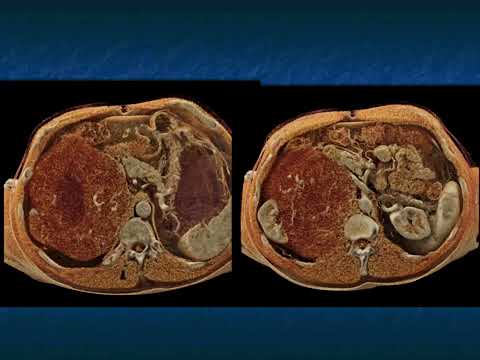 CT of the Large (greater than 4cm) Adrenal Mass: Pearls and Pitfalls - Part 5