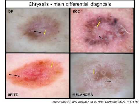 Melanoma diagnosis by Dr. A. Scope 2/2