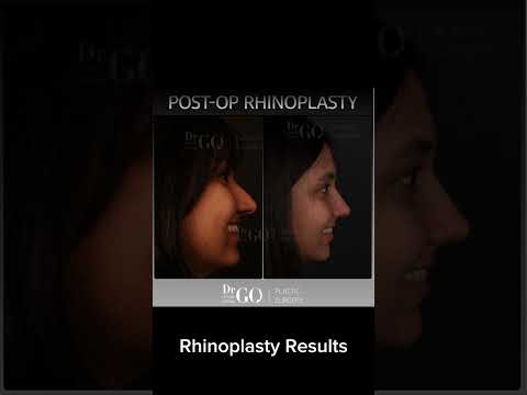 Before and after Rhinoplasty - Dr Guncel Ozturk #rhinoplastyturkey #beforeandafter #drgo #nosejob