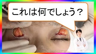 見ないでください、苦手な方は。二重全切開法の手術動画です。サムネの黄色いものは何でしょうか？