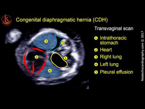 Fetal echocardiography at 11-13 weeks: Congenital Diaphragmatic Hernia (CDH)