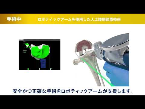 ロボティックアームを使用した人工膝関節置換術