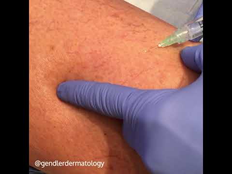 Sclerotherapy treatment for varicose veins I Gendler Dermatology