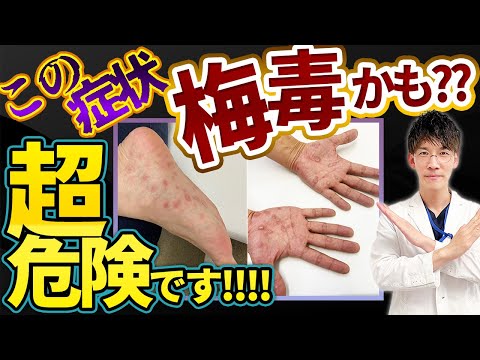 【放置厳禁！！】激増している梅毒の症状・検査・治療・根本的な予防法について泌尿器科専門医が解説します。