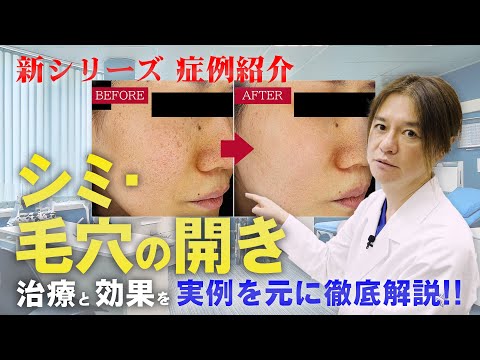 【新シリーズ】実際の症例をもとにシミ・毛穴の開きの治療について徹底解説！レーザーフェイシャル！POTENZA(ポテンツァ)！その効果は！？【症例紹介】