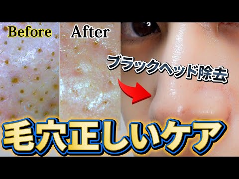 イチゴ鼻のブラックヘッドと角栓を除去して毛穴小さくする方法！ [Black head remover skincare]