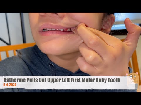 Katherine Pulls Out Upper Left First Molar Baby Tooth