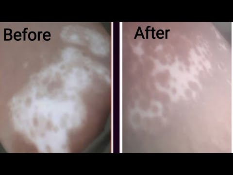 😱 मिल गया सफेद दाग जड़से मिट़ाने का 100% कारगर आयूर्वेदिक नूस्खा।Vitiligo treatment।leukoderma cure