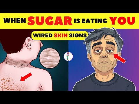 5 skin signs that you could be eating too much sugar | Effects of sugar on the body | Sugar cravings