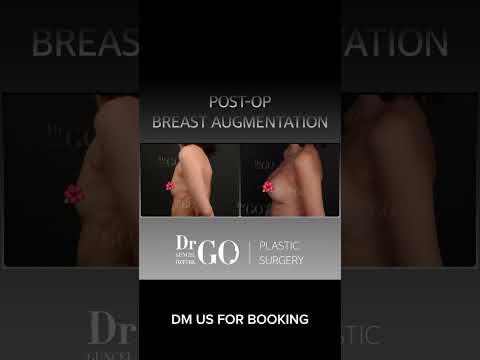 Before and after breast augmentation - Dr Guncel Ozturk #guncelozturk #drgo