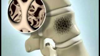 Vertebral Compression Fracture - DePuy Videos