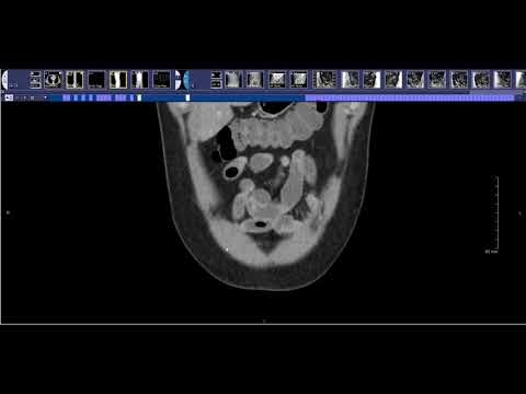 How to read a CT Enterography