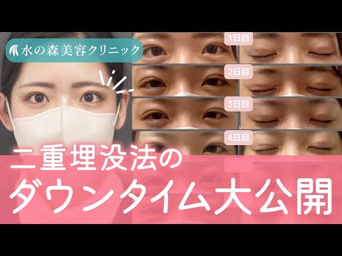 【経過】痛みは？どのくらい腫れる？二重埋没法のダウンタイムを大公開！【水の森美容クリニック】