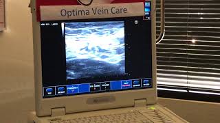 EndoVenous Laser Ablation Right Great Saphenous Vein