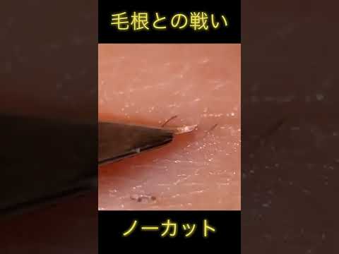 しつこい毛根との戦いノーカット