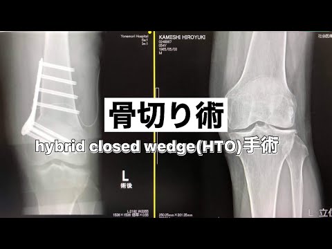 【半月板損傷】骨切り術　運動が出来るようになりました