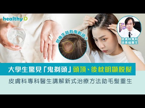 鬼剃頭(斑禿)｜年青女生都會突然甩頭髮！了解最新治療方法  加快頭髮重生