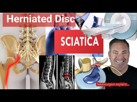 Outdoorsman, hunter, grown up girl dad: "Do I have to have surgery?" | Herniated disc with sciatica