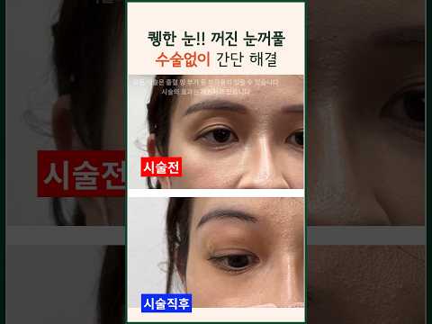 눈꺼풀 꺼짐 퀭한 눈위 볼륨 채우기 | 특수부위 필러 #modsclinic #filler #모즈클리닉