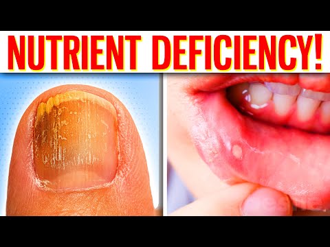 The 10 Hidden Signs Of Nutrient Deficiency You Should Never Ignore