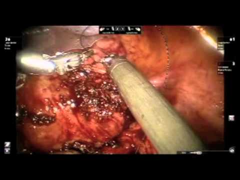 robotic myomectomy by Dr Rooma sinha  hyderabad India