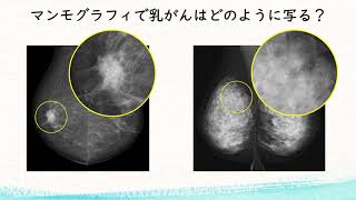 マンモグラフィ検査でわかる「高濃度乳房」ってどんなもの？