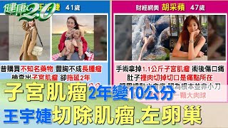 子宮肌瘤2年變10公分 王宇婕切除肌瘤.左卵巢 健康2.0