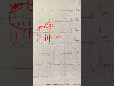 Hyperkalemia - Peaked T-Waves - and ECG Recognition