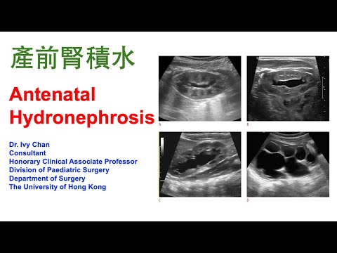 產前腎積水 Antenatal Hydronephrosis by Dr. Ivy Chan (10 Dec 2024)