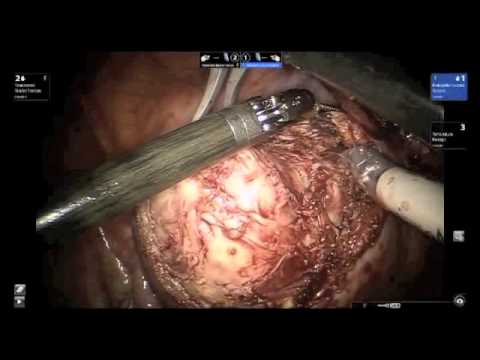 ROBOTIC MYOMECTOMY performed by Dr Rooma Sinha, Hyderabad India