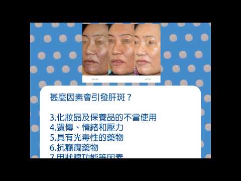 認識肝斑的成因與治療