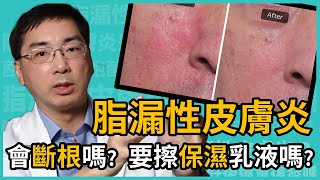 脂漏性皮膚炎會斷根嗎？需擦保濕乳液嗎？皮膚科林政賢醫師完整保養教學一次告訴你！