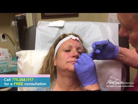 Juvederm Voluma Injections in the Cheek and Cheekbone Area - Reno Sparks MedSpa