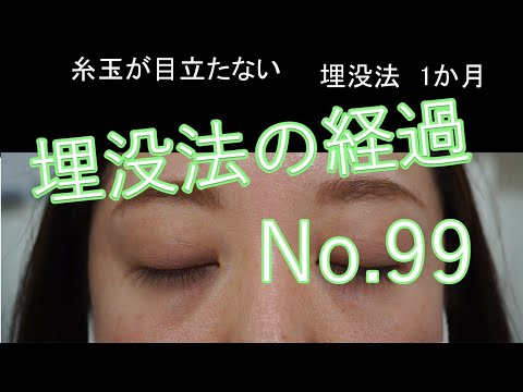 糸玉の目立たない埋没法　No99