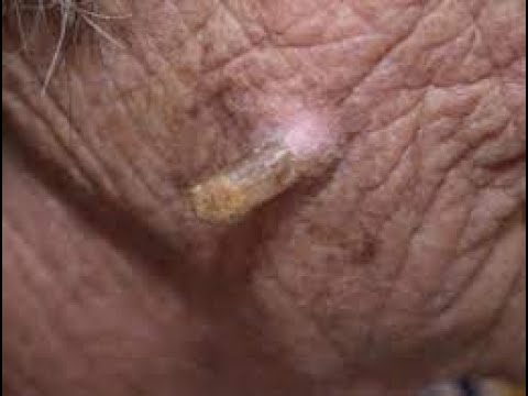 huge blackheads on face new this week