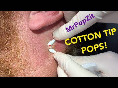 A quick popping session to hold you over! Shallow follicular cysts extracted. With Bonus blackhead