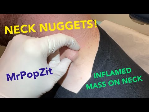 Neck nugget mass removed and dissected. Is it a lymph node? Watch and find out!