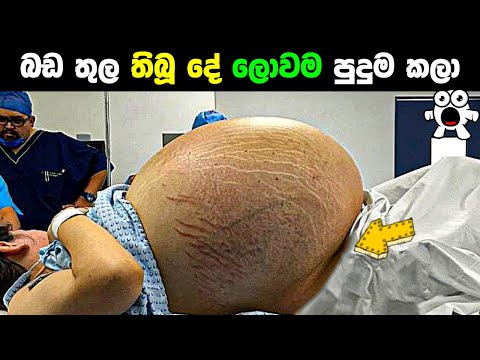 ඇත්ටම බඩ ඇතුලේ තිබුනේ මොනාද ? Mom thinks she’s having twins,Then doctor spots something incredible