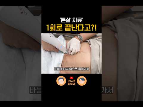 튼살 치료 '이것' 하시면 1회로 끝낼 수 있어요